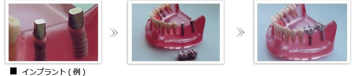 友岡歯科のインプラントの画像